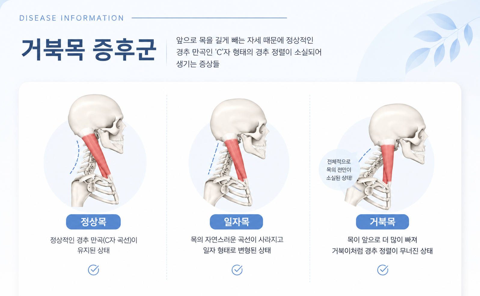 늘 무거운 뒷목과 두통, 혹시 나도 거북목? 1초 자가진단법과 교정 스트레칭!